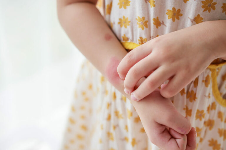 Kožné problémy u detí v lete: Dermatológ varuje pred týmito komplikáciami